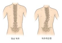 척추측만에 필라테스가 좋을까?