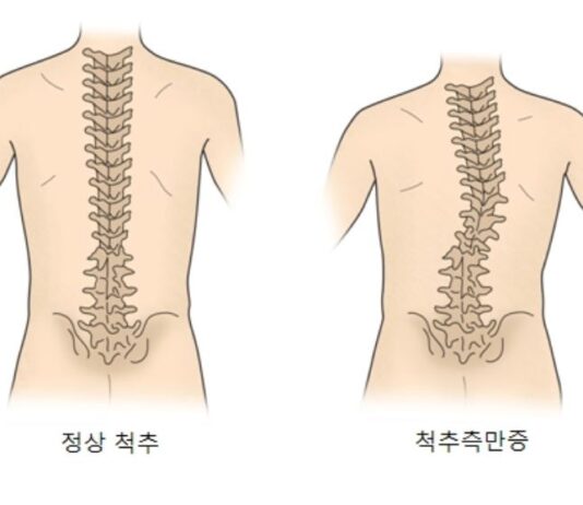 척추측만에 필라테스가 좋을까?