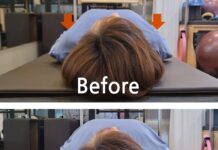 어깨 뼈가 앞으로 튀어나와 있다면? 라운드 숄더와 다른 ‘이것’ 일수도