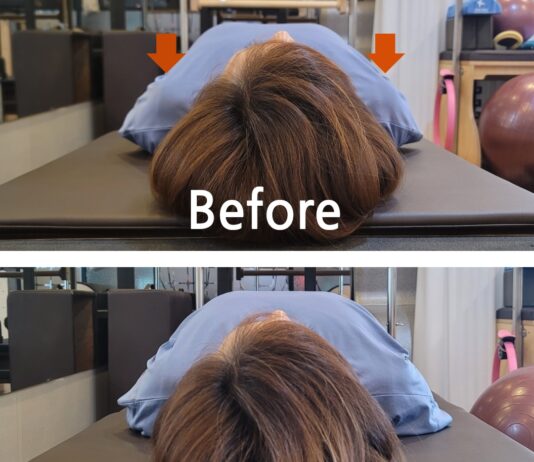 어깨 뼈가 앞으로 튀어나와 있다면? 라운드 숄더와 다른 ‘이것’ 일수도