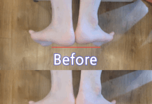 이제필라테스 교정 사례, 짝다리 짚지 마세요