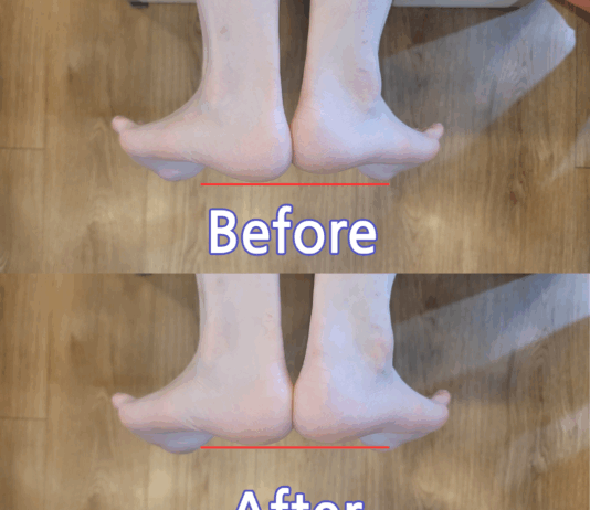 이제필라테스 교정 사례, 짝다리 짚지 마세요