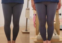 이제 필라테스, 오다리 교정 사례 공개