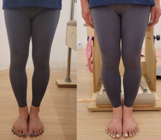 이제 필라테스, 오다리 교정 사례 공개