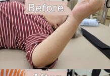 이제 필라테스, 오십견 재활 운동 사례